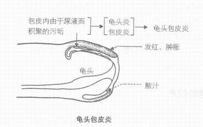 龟头炎和梅毒区别照片图片